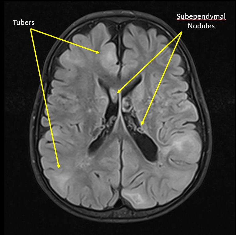 tuberous sclerosis image
