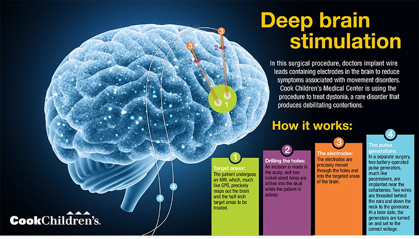 Celebrating 10 Years Of Deep Brain Stimulation – The Arcuate ...